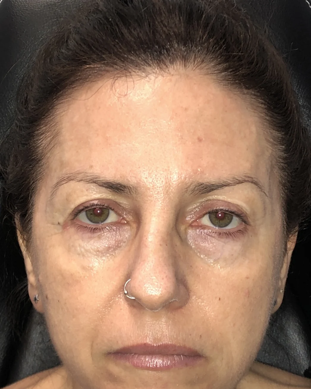 Blefaroplastia, cirugía de ptosis, cejaplastia de cola y cantopexia bilateral: la mirada antes de la intervención