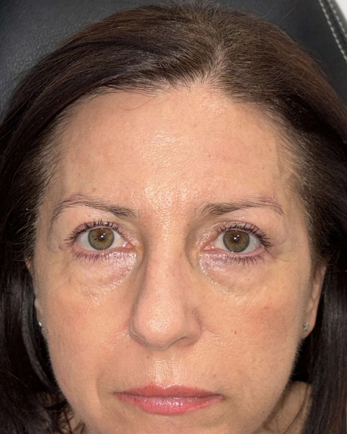 Blefaroplastia, cirugía de ptosis, cejaplastia de cola y cantopexia bilateral: la mirada después de la intervención