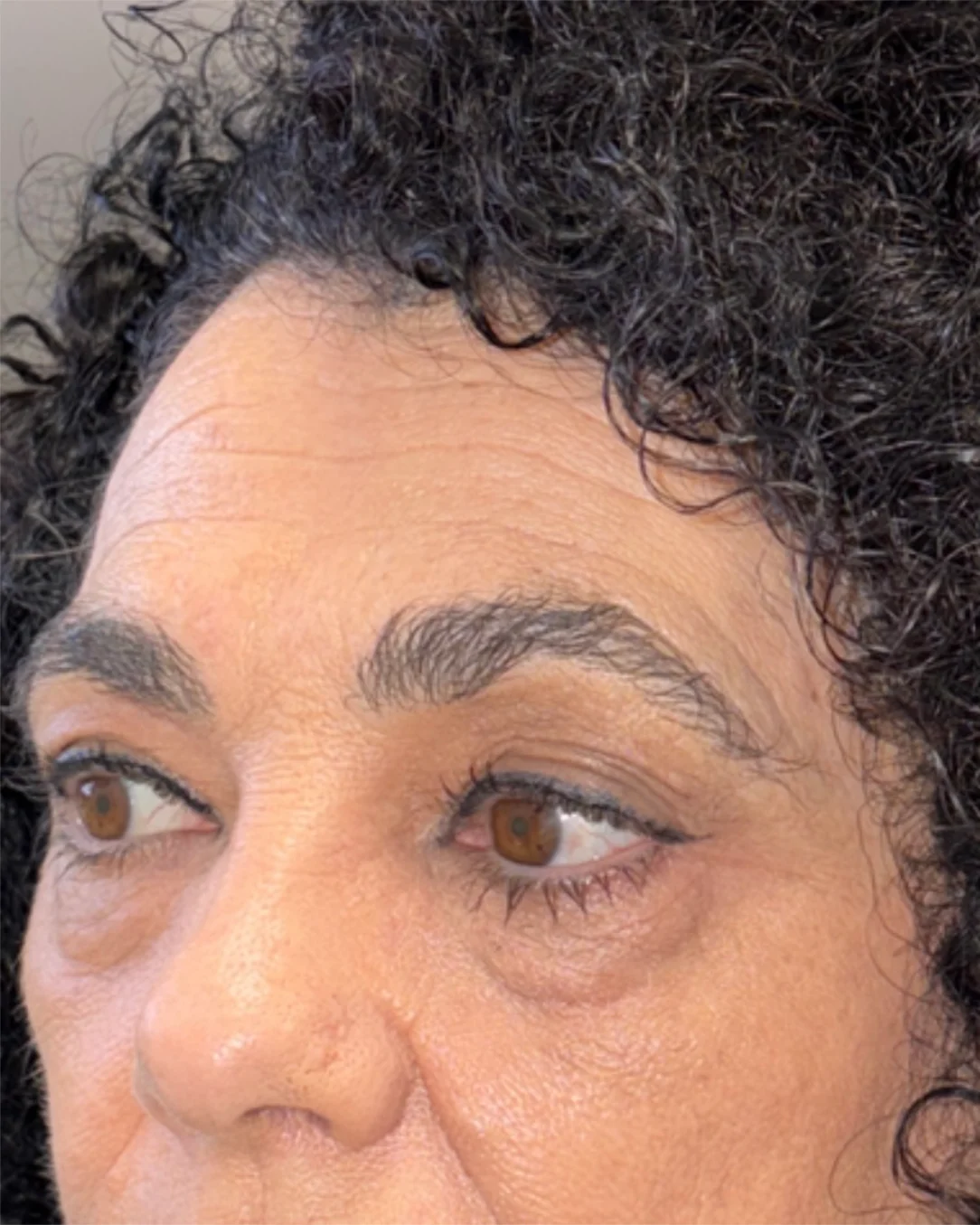 Blefaroplastia completa con transposición grasa y cejaplastia de cola: la mirada antes de la intervención