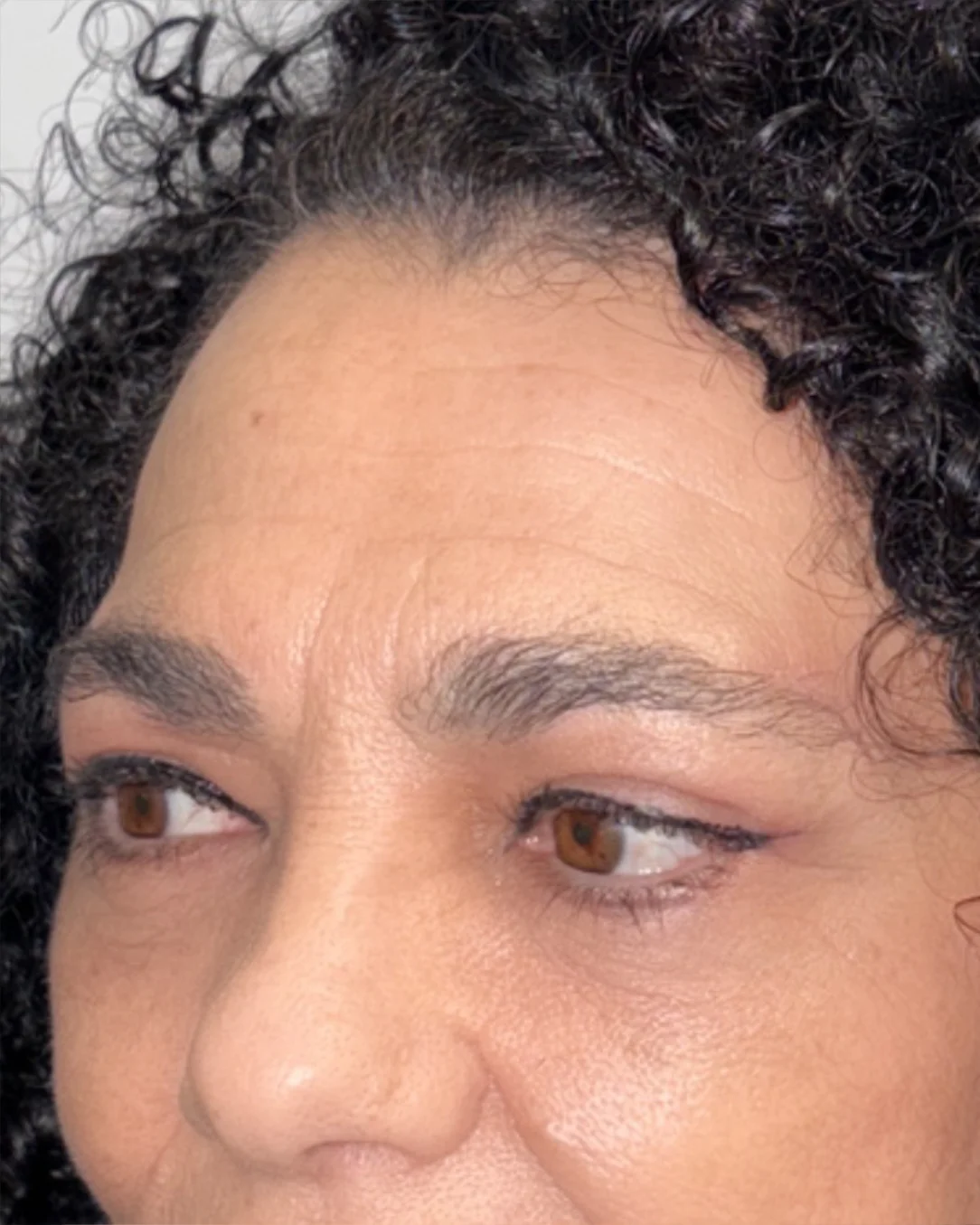 Blefaroplastia completa con transposición grasa y cejaplastia de cola: la mirada después de la intervención