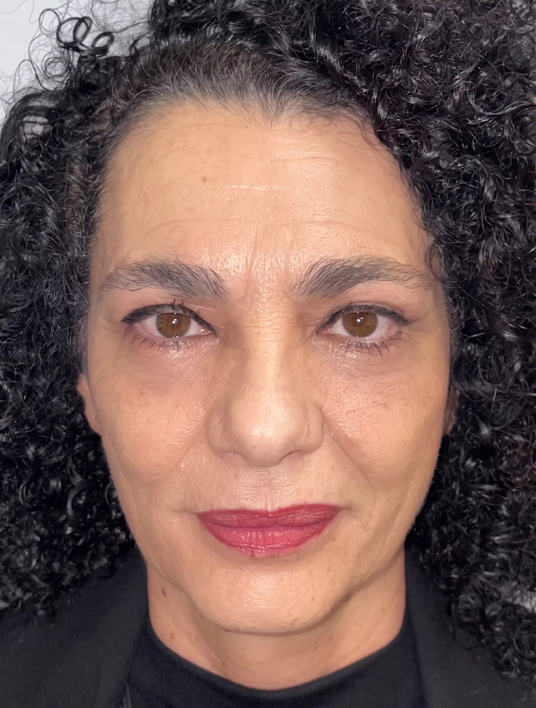 Blefaroplastia completa con transposición grasa y cejaplastia de cola: el rostro completo después de la intervención
