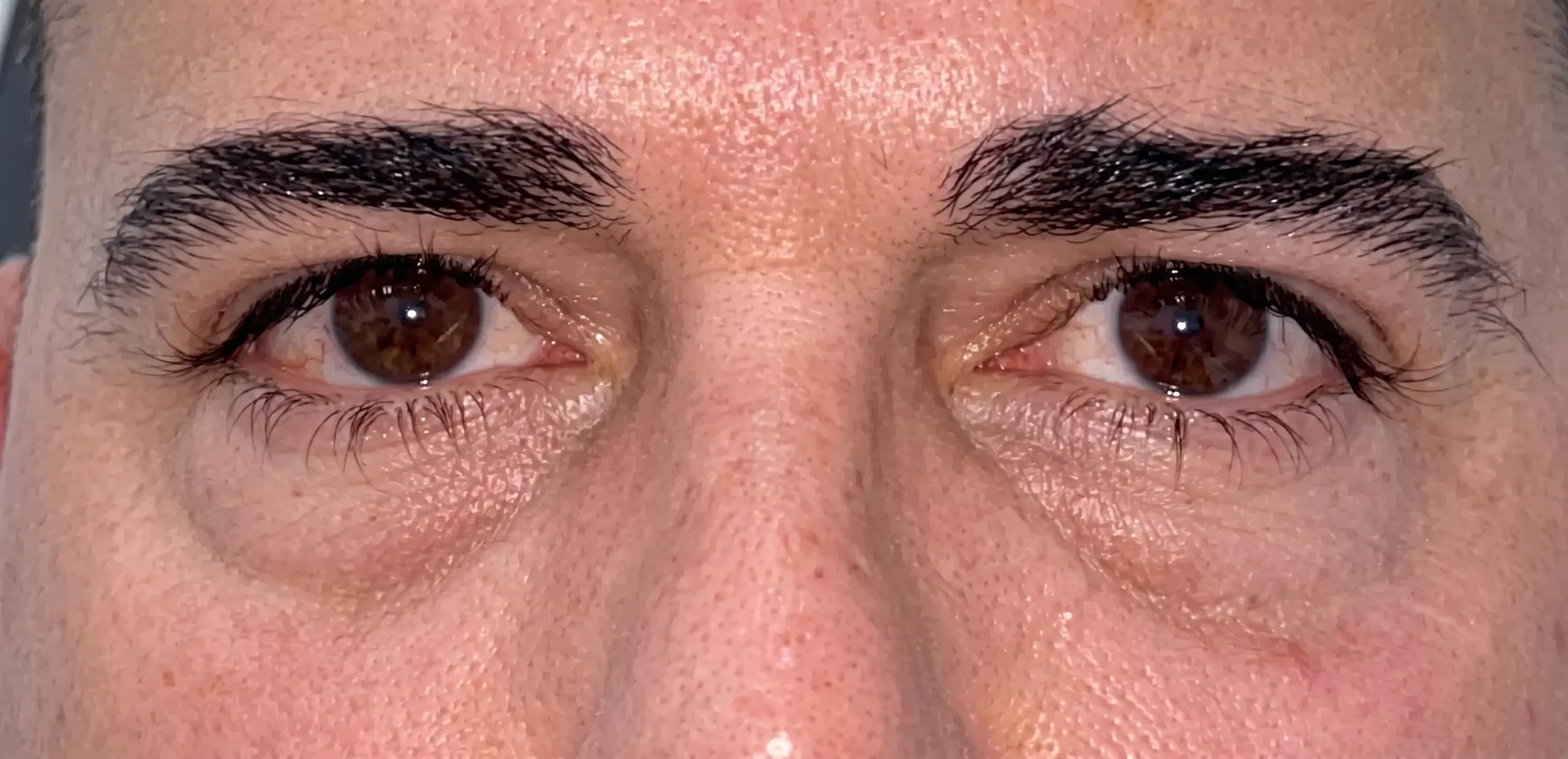 Blefaroplastia inferior con lipectomía: la mirada antes de la intervención