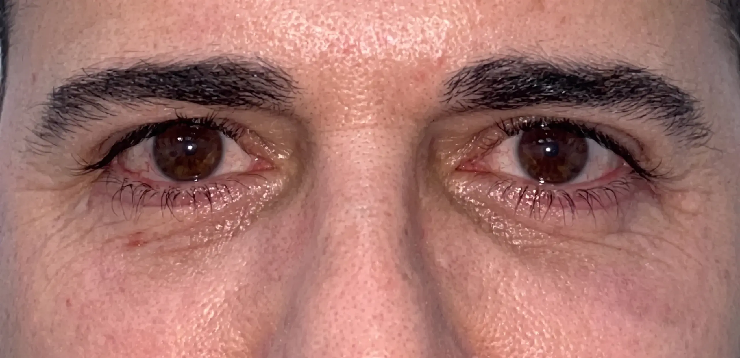 Blefaroplastia inferior con lipectomía: la mirada después de la intervención