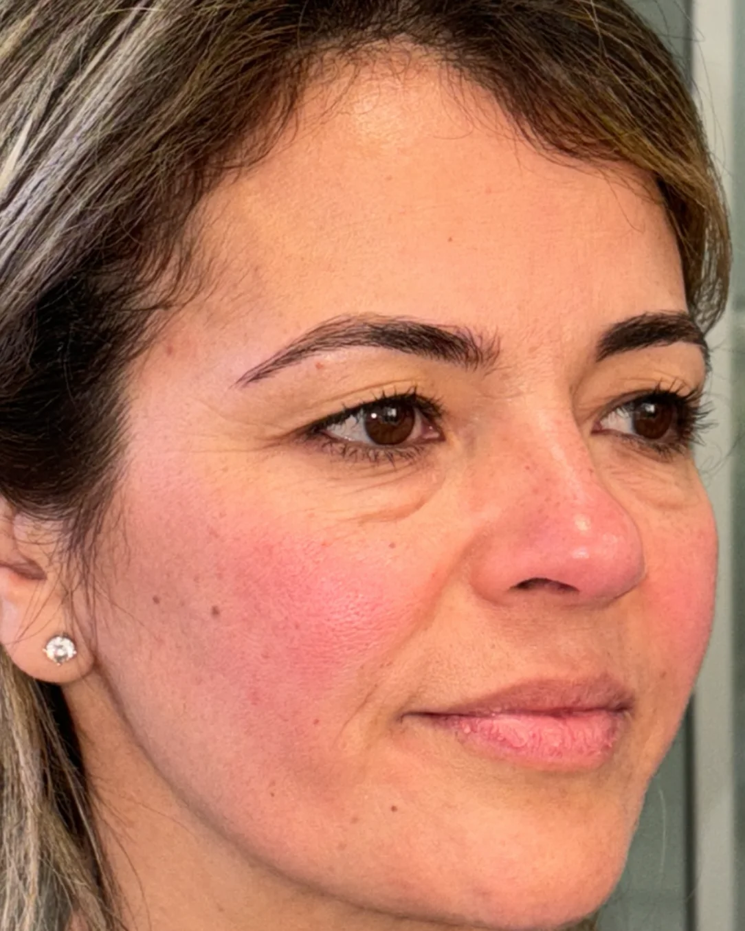 Blefaroplastia completa con transposición grasa y cejaplastia asimétrica: la mirada antes de la intervención