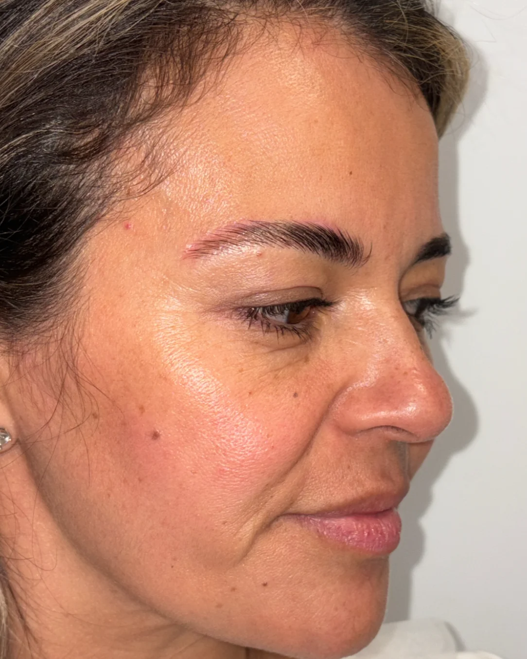Blefaroplastia completa con transposición grasa y cejaplastia asimétrica: la mirada después de la intervención
