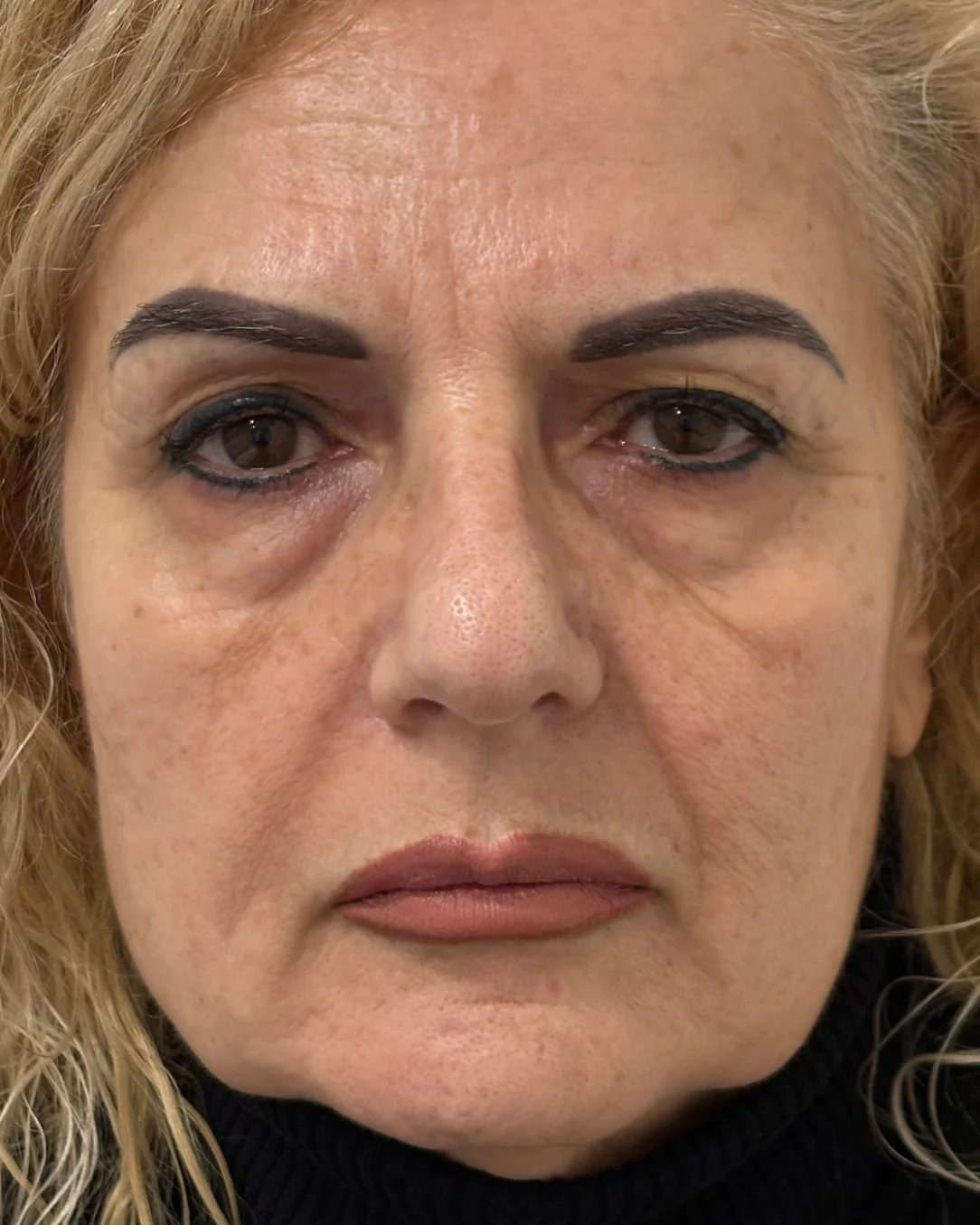 Blefaroplastia completa, cejaplastia de cola y resurfacing periocular con láser: la mirada antes de la intervención