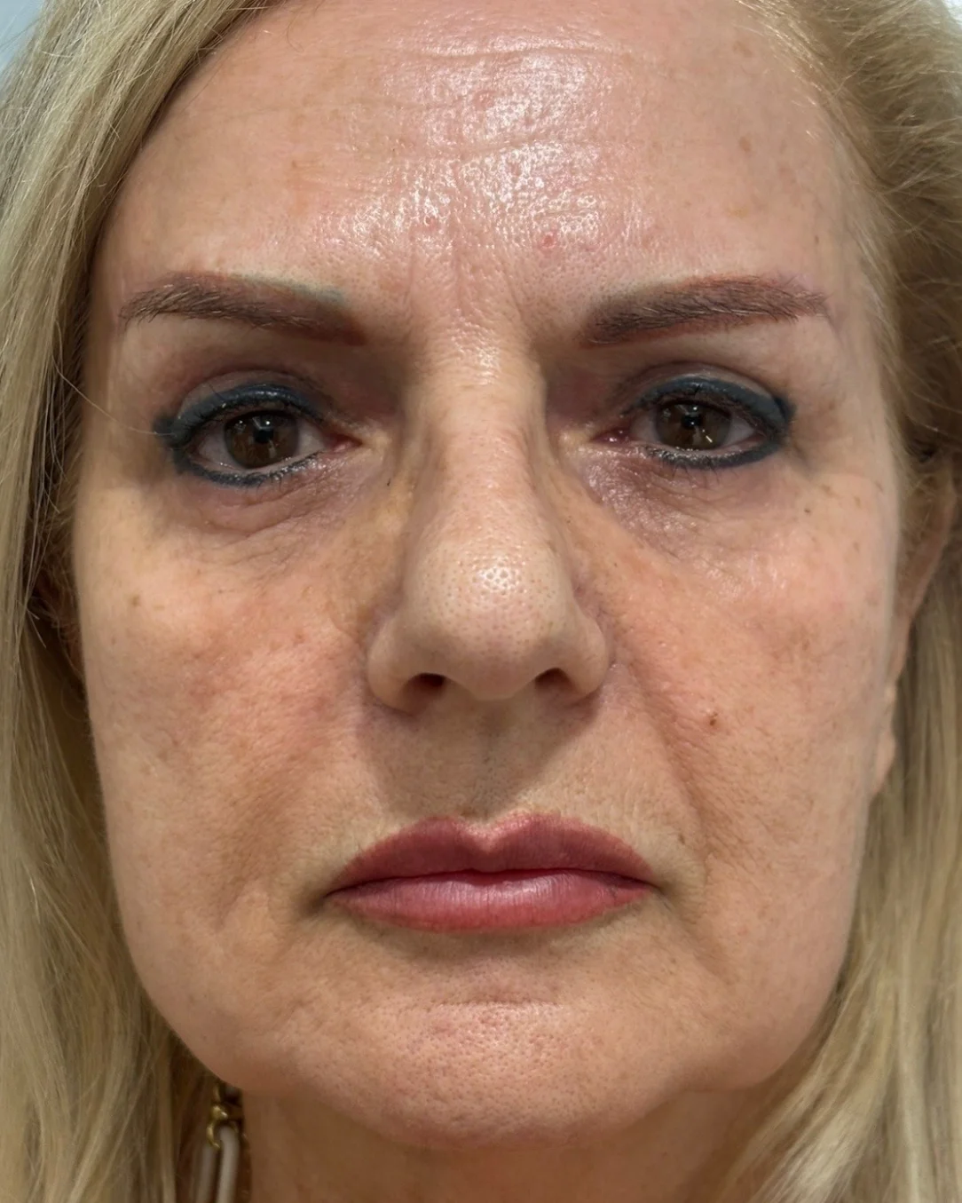Blefaroplastia completa, cejaplastia de cola y resurfacing periocular con láser: la mirada después de la intervención