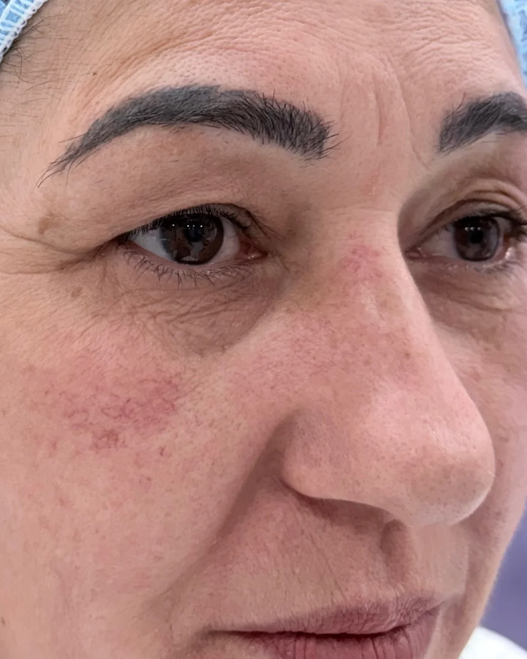 Blefaroplastia superior, cejaplastia de cola y resurfacing con láser Erbio:Yag: la mirada antes de la intervención