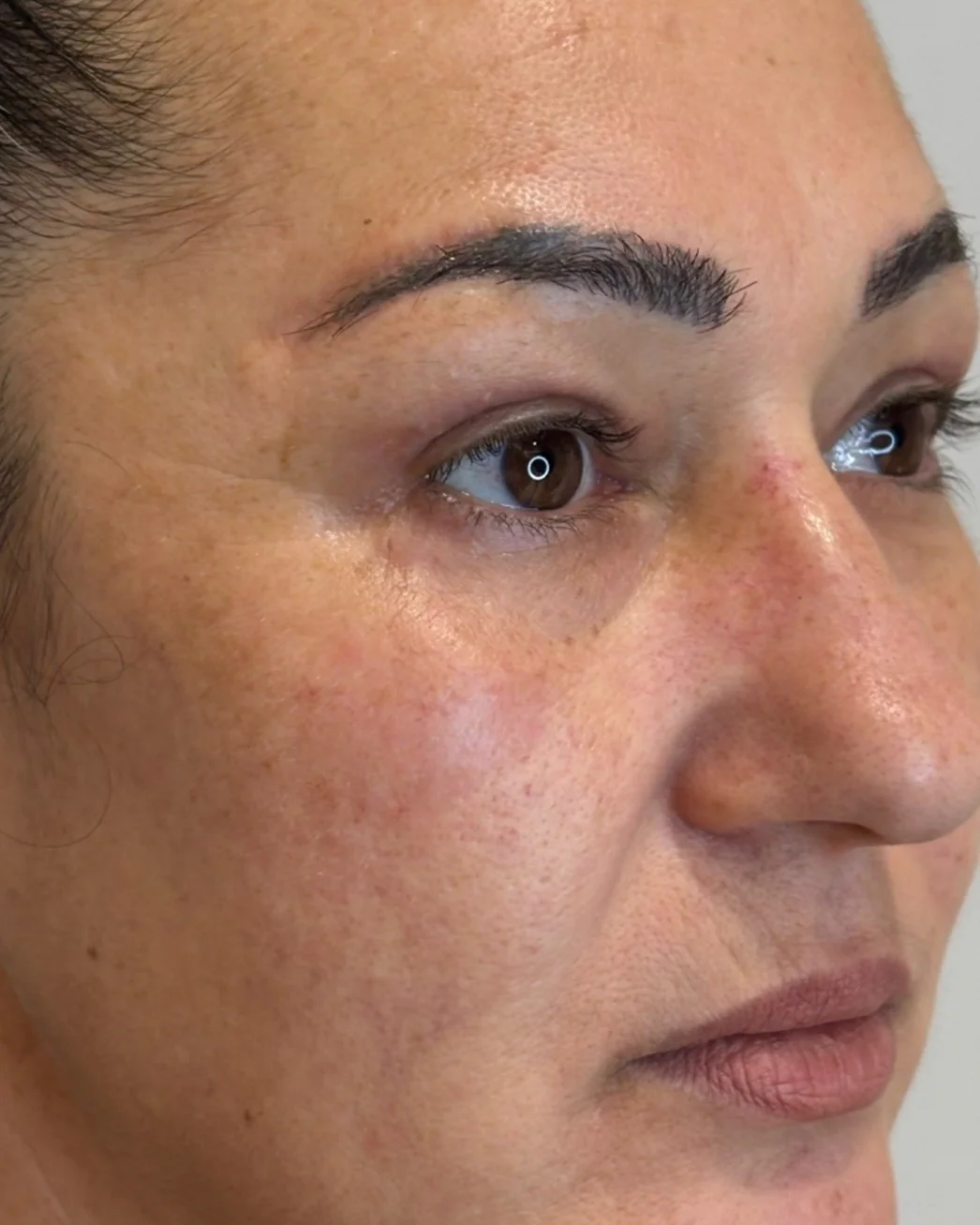 Blefaroplastia superior, cejaplastia de cola y resurfacing con láser Erbio:Yag: la mirada después de la intervención