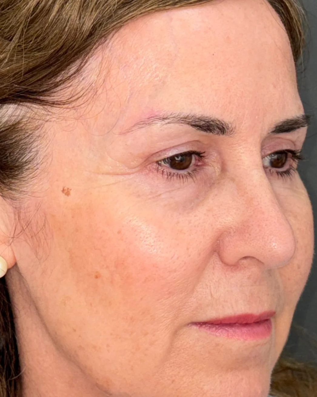 Blefaroplastia superior y cejaplastia de cola: la mirada después de la intervención