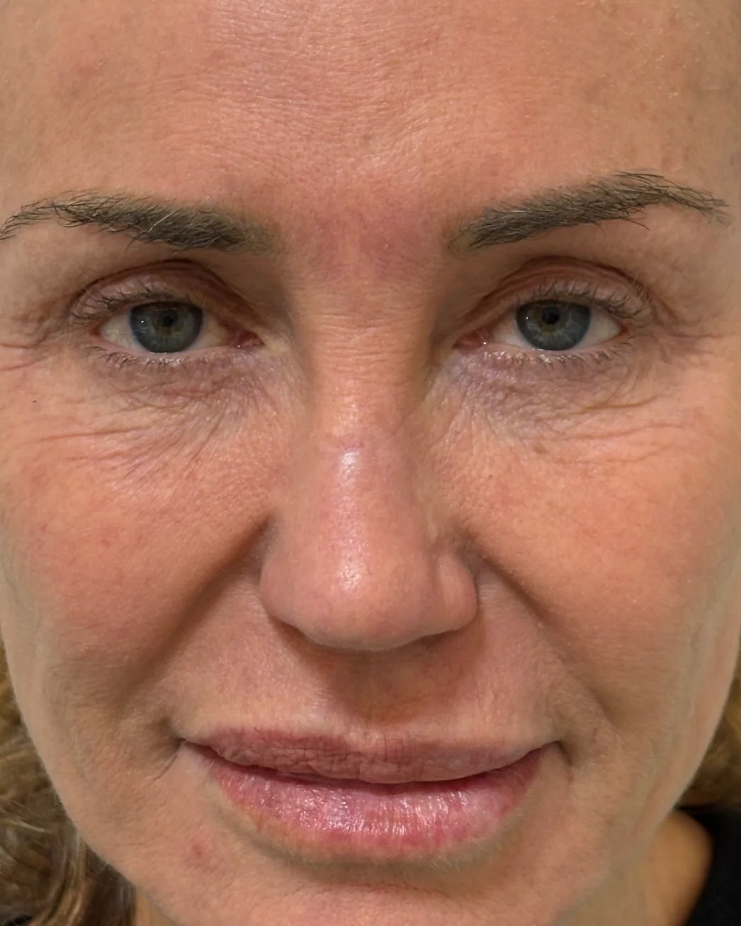 Ajuste cutáneo inferior, resurfacing con láser Erbio:Yag y blefaroplastia superior: la mirada antes de la intervención