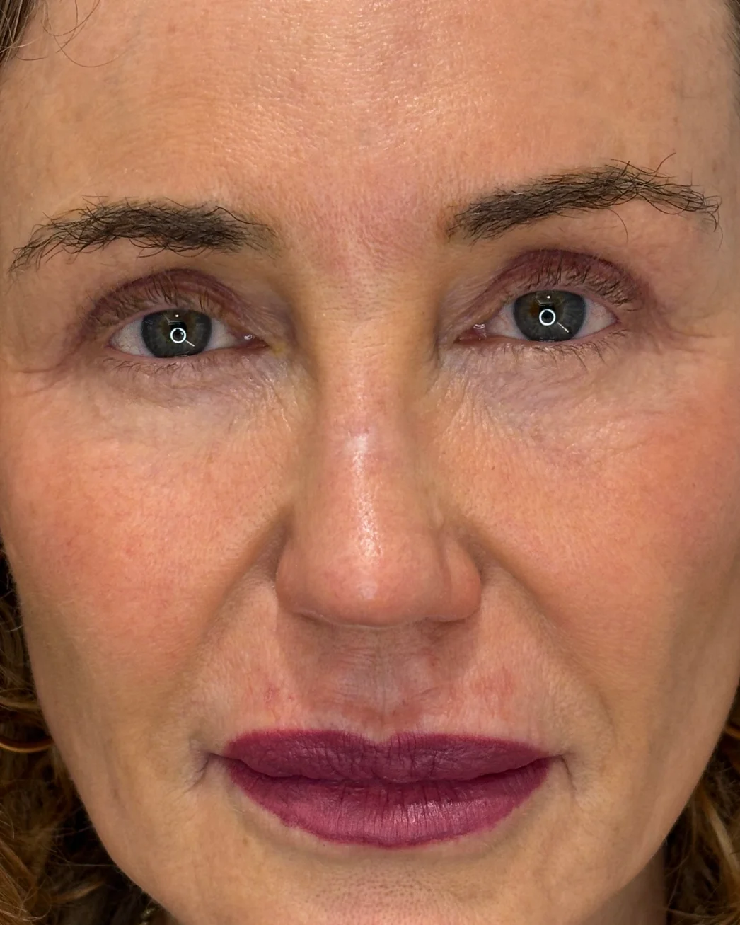 Ajuste cutáneo inferior, resurfacing con láser Erbio:Yag y blefaroplastia superior: la mirada después de la intervención
