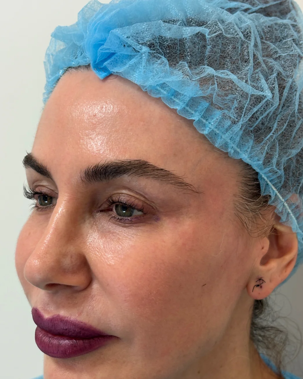 Blefaroplastia superior muy medida: la mirada antes de la intervención