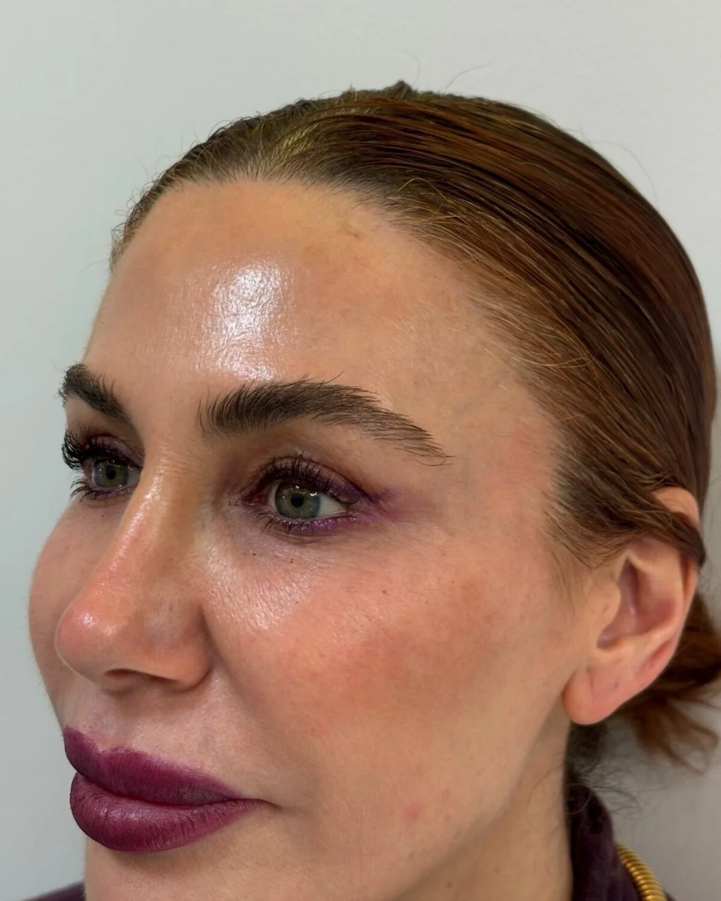 Blefaroplastia superior muy medida: la mirada después de la intervención