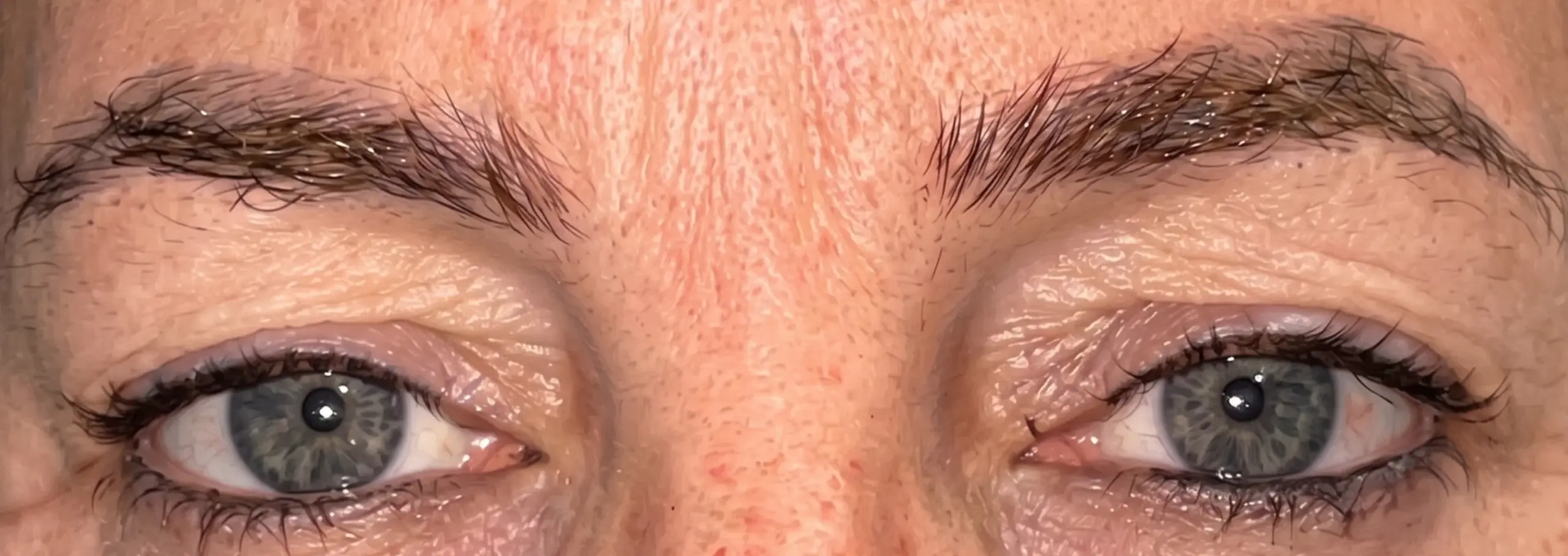 Blefaroplastia superior con punto de brassiere: la mirada antes de la intervención