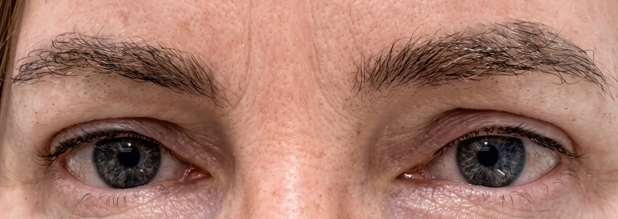 Blefaroplastia superior con punto de brassiere: la mirada después de la intervención
