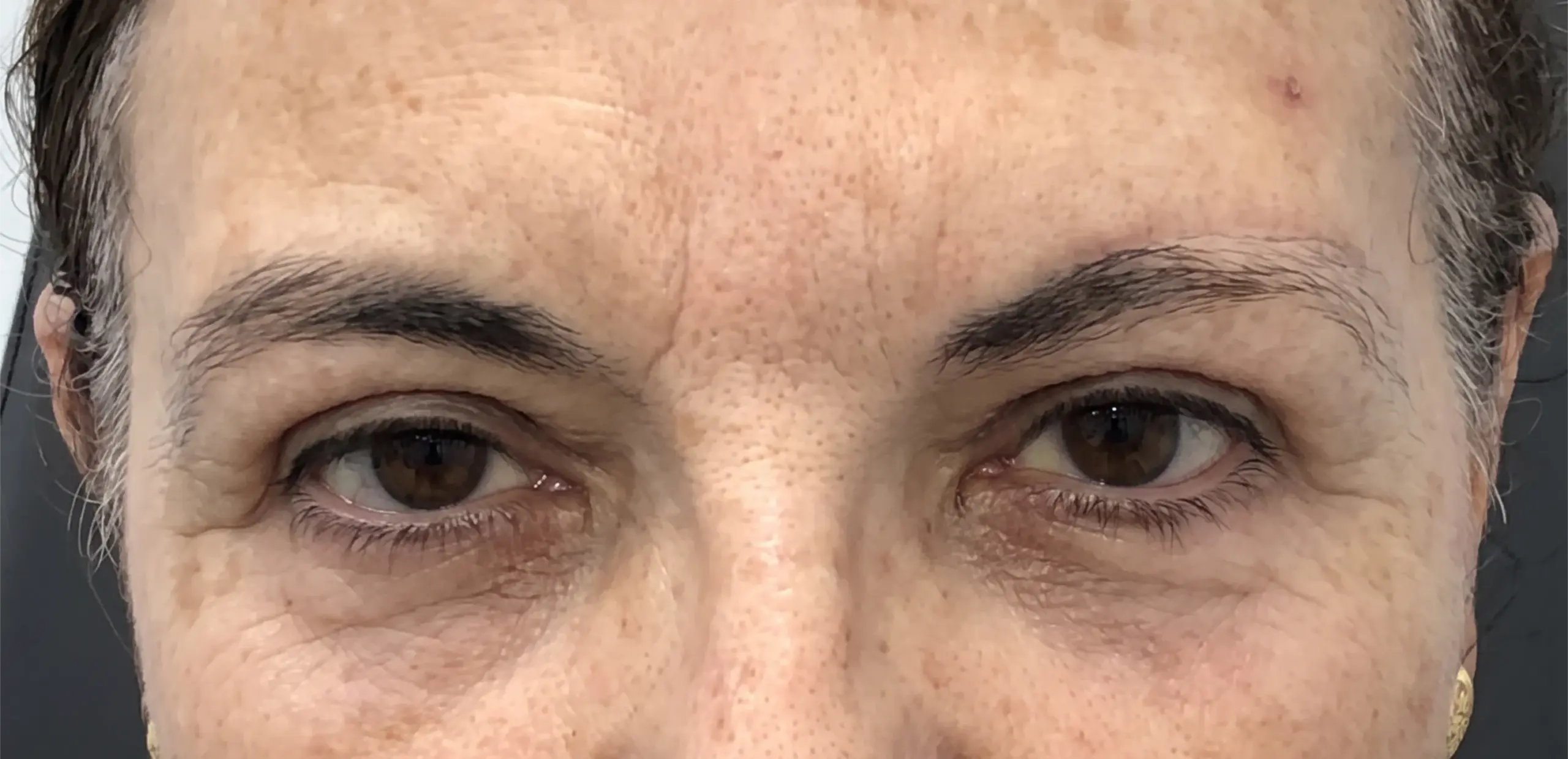 Blefaroplastia superior, cejaplastia directa y cantopexia lateral: la mirada después de la intervención