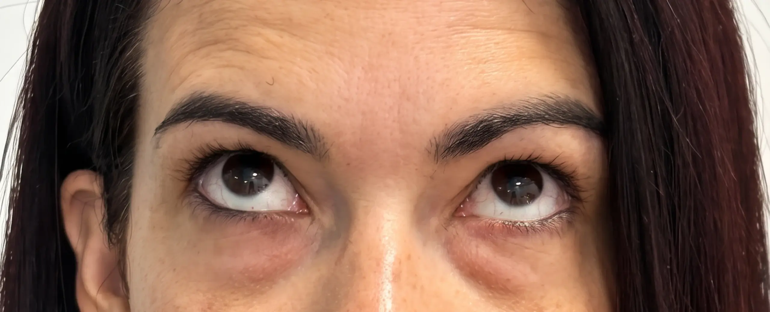 Blefaroplastia inferior con transposición grasa y cejaplastia de cola: la mirada antes de la intervención
