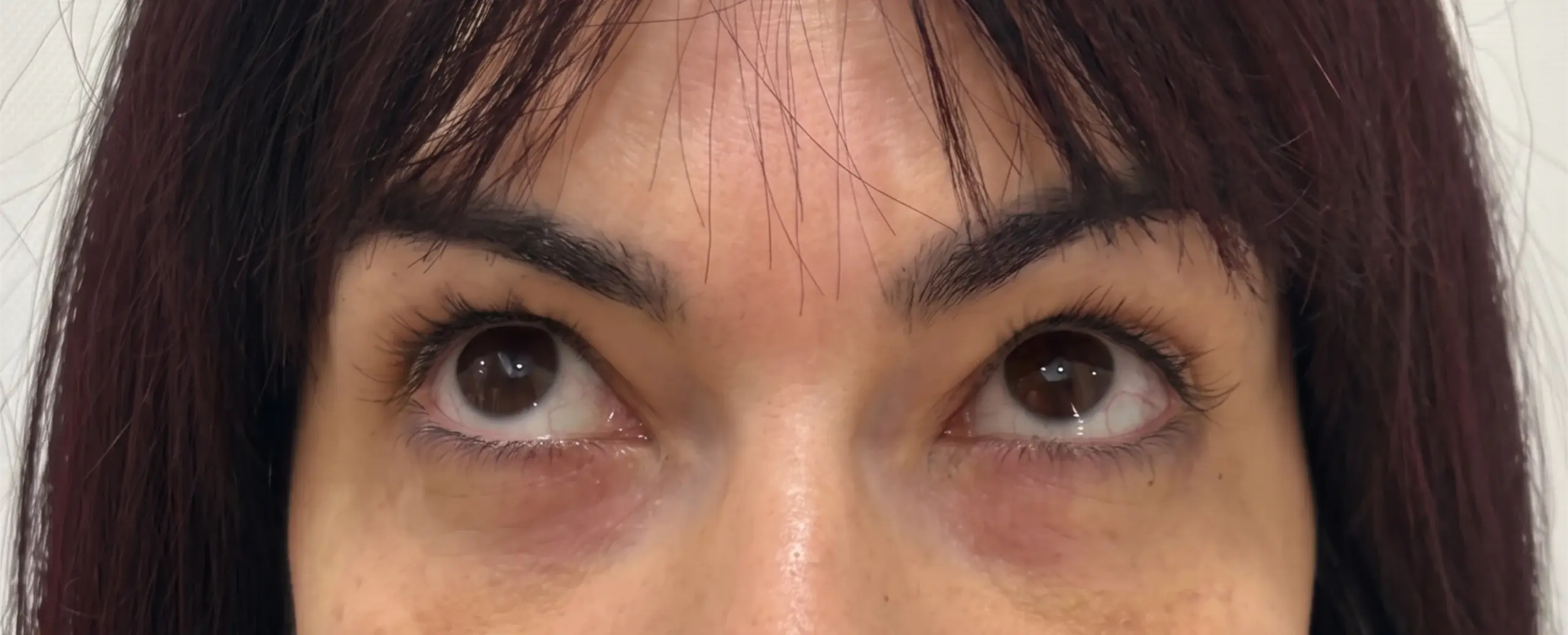 Blefaroplastia inferior con transposición grasa y cejaplastia de cola: la mirada después de la intervención